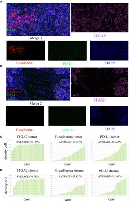 High expression ITGA2 affects the expression of MET, PD-L1, CD4 and CD8 with the immune microenvironment in pancreatic cancer patients